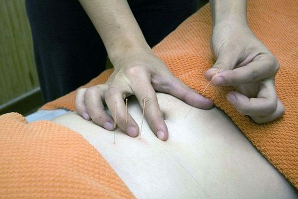 How Acupuncture Can Help Your Body