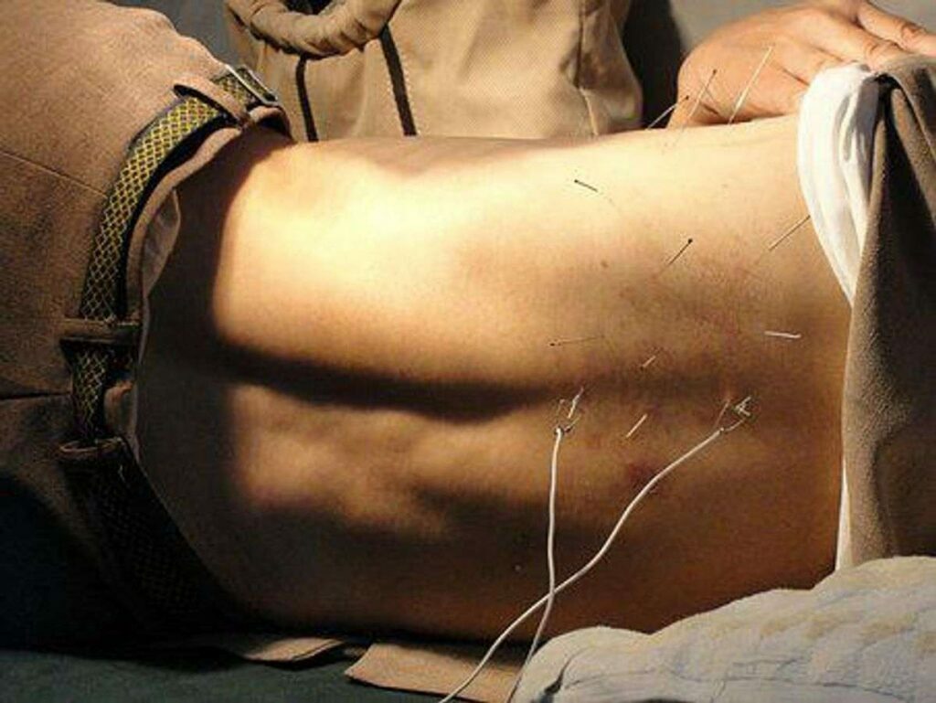 How Does Acupuncture Work