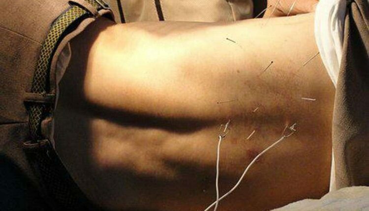 How Does Acupuncture Work