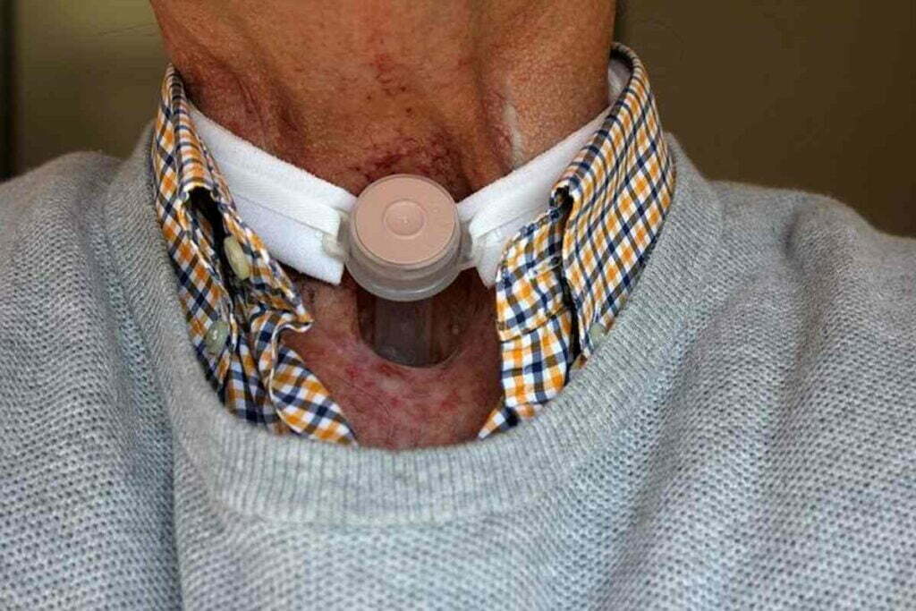 Misdiagnosis of Larynx Cancer