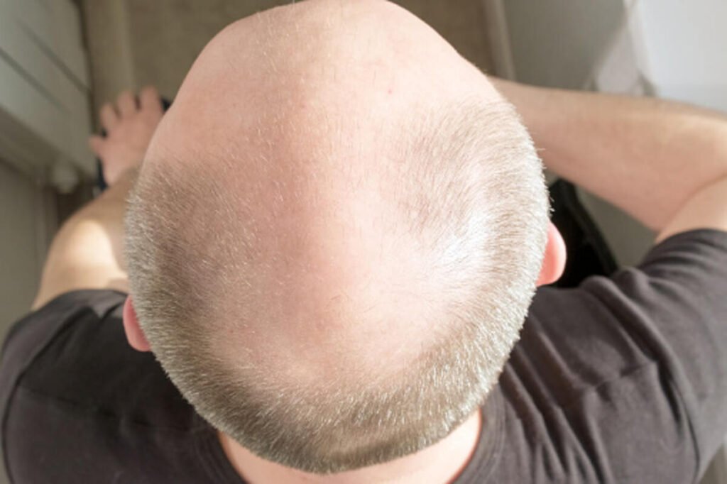 alopecia areata