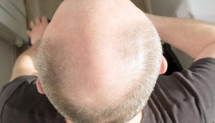 alopecia areata