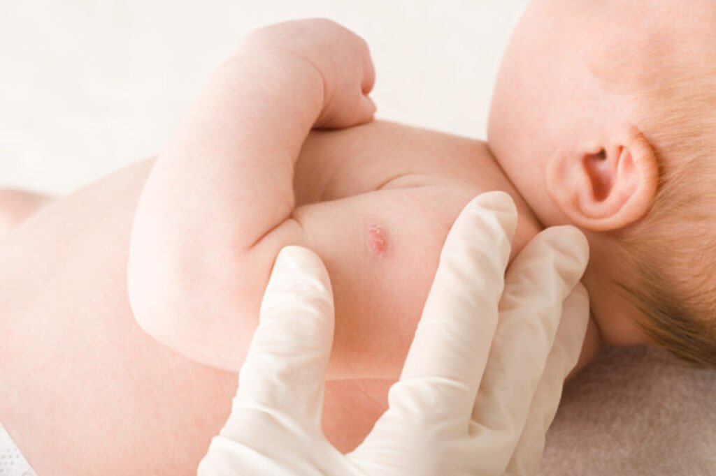rotavirus