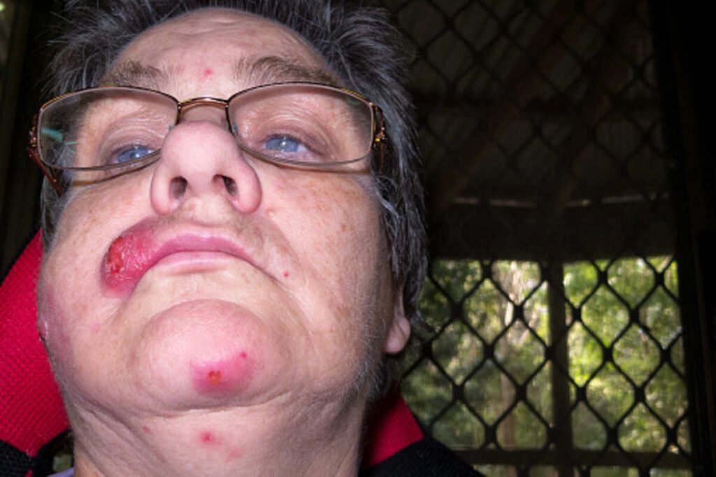staph infection