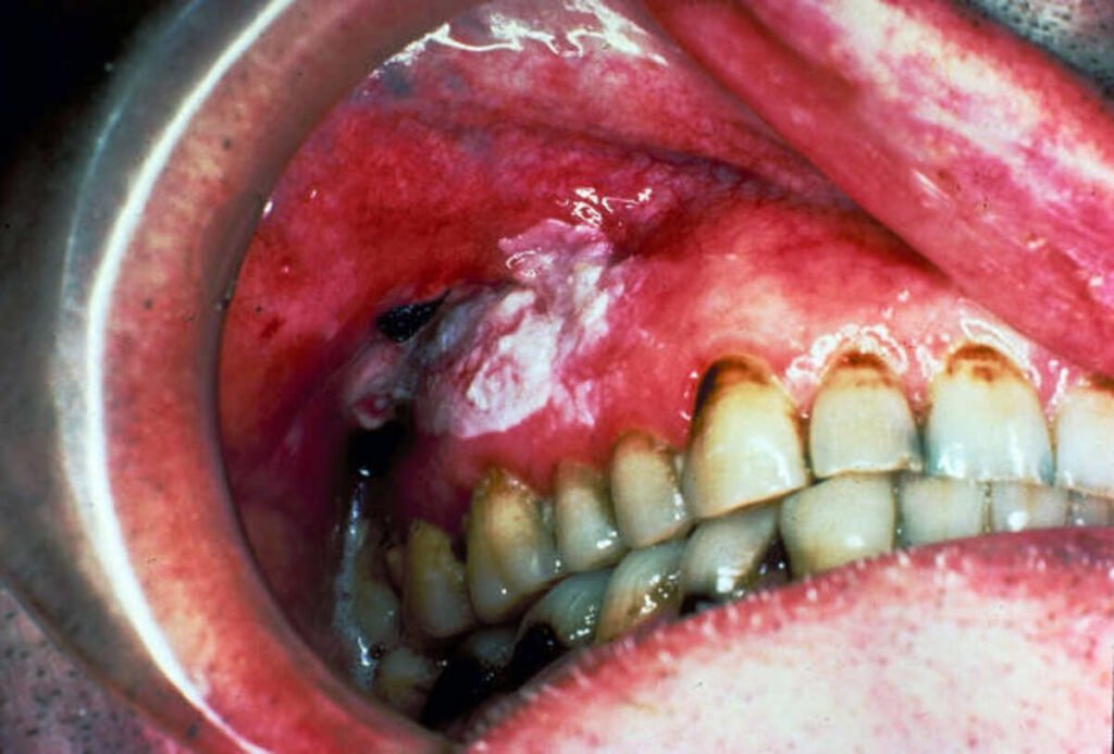 leukoplakia