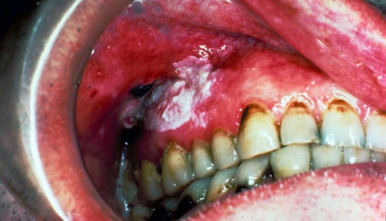 leukoplakia