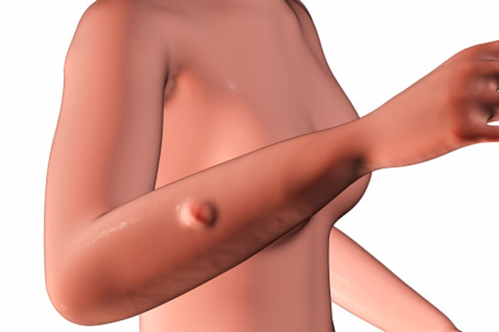 lipedema